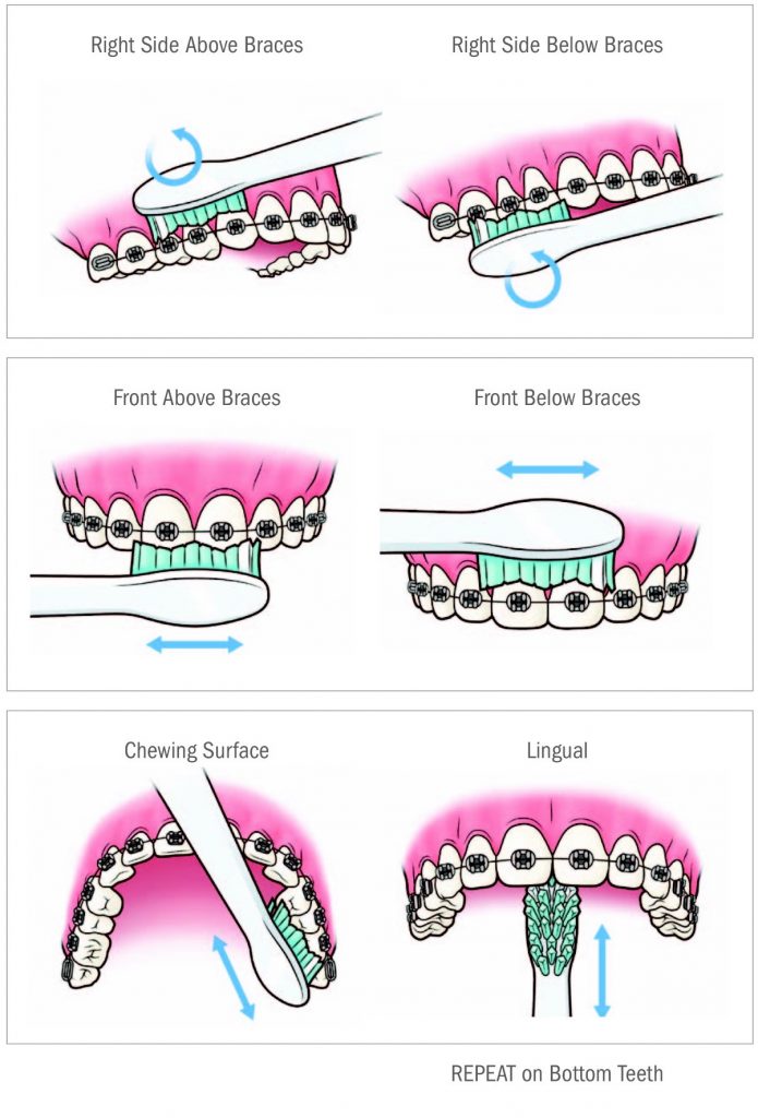 Brushing Technique for Patients with Braces Uttam Dental Clinic